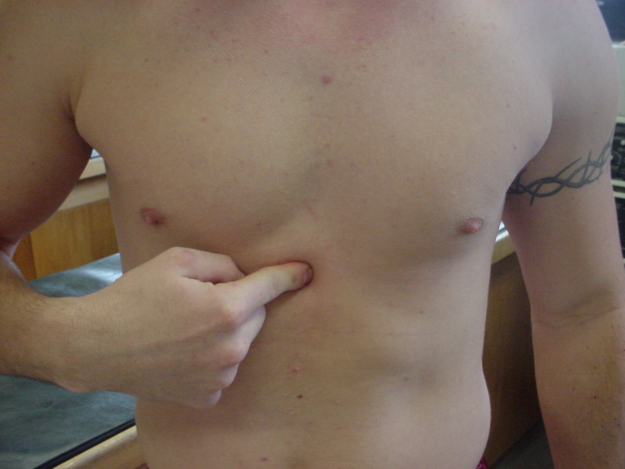 уплотнение под кожей в груди у мужчин фото 107